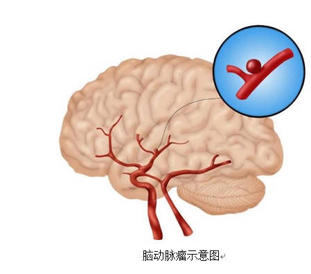 藏于顱內(nèi)的定時(shí)炸彈——腦動(dòng)脈瘤